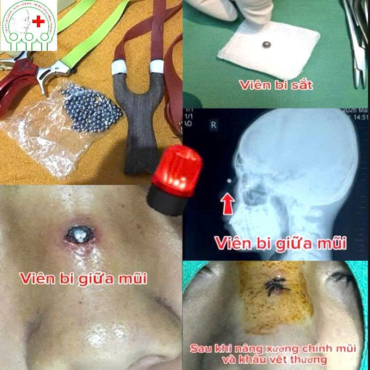 gay xuong chinh mui do bi sat   ??bi sat dinh vao mui ?? nguy hiem khi choi na ban bi sat